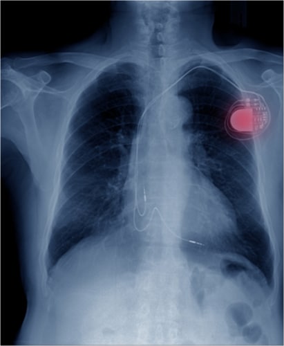 X-ray of human chest showing medical implant device
