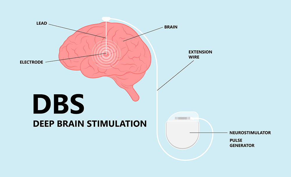 Illustration pointing out where the parts of a neurostimulator go on the human brain